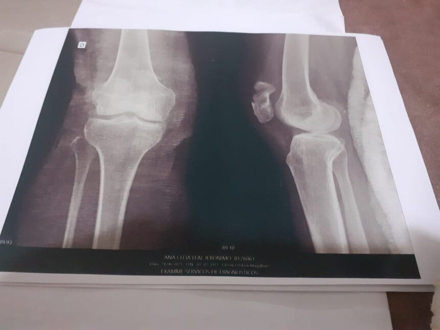 Autônoma aguarda há 45 dias por cirurgia no joelho no HGR