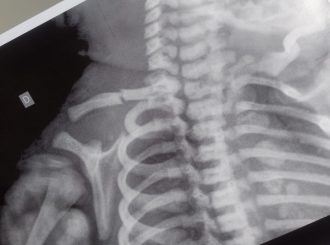 Bebê teve clavícula quebrada durante parto e família não consegue apoio na maternidade