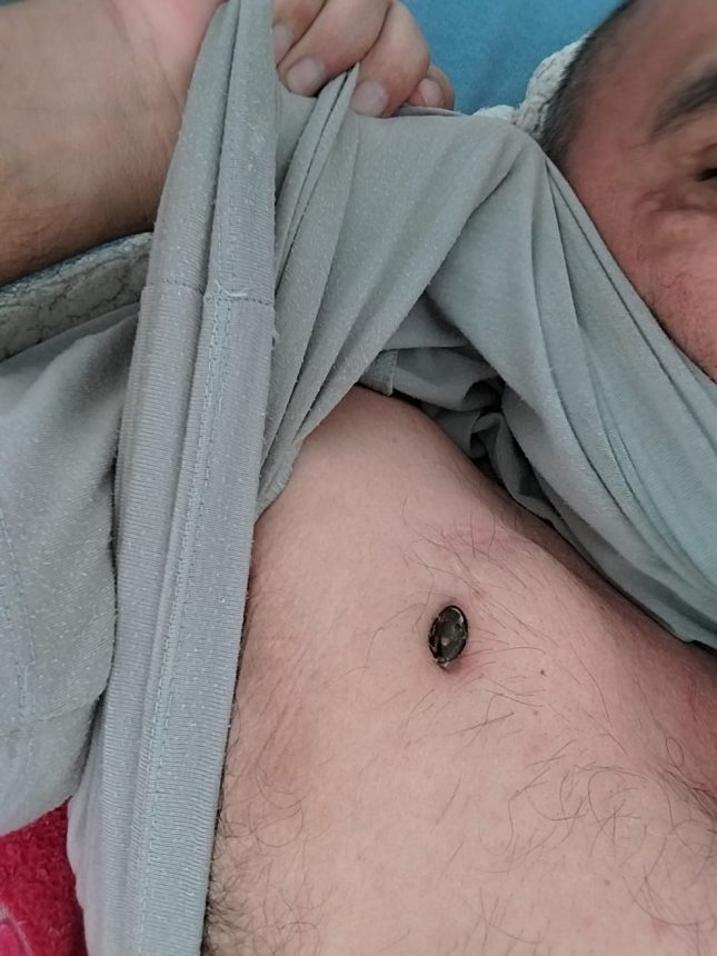 Homem com marcapasso saindo do peito tem TFD cancelado pela Sesau