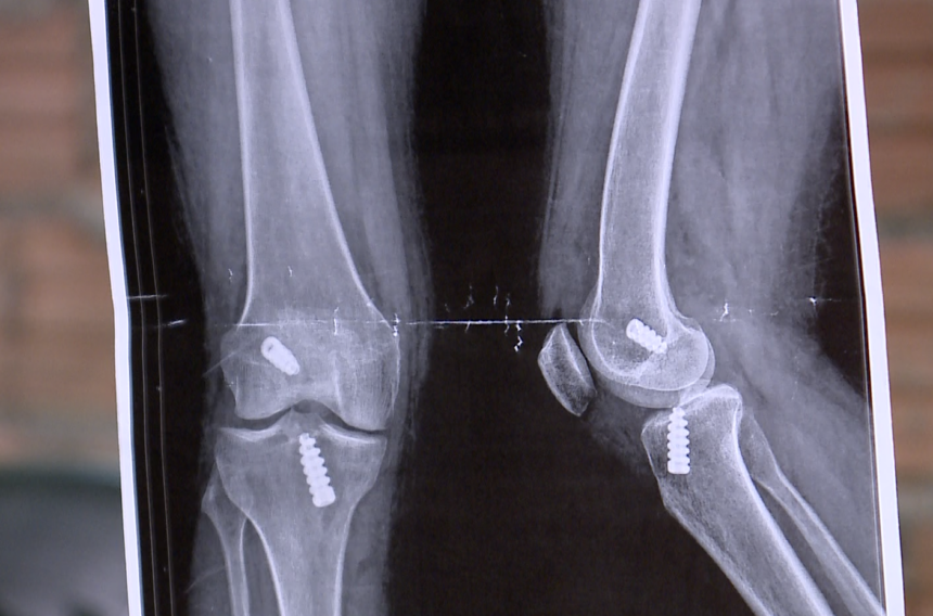 Mulher não consegue andar após erro em cirurgia ortopédica no HGR, diz denúncia