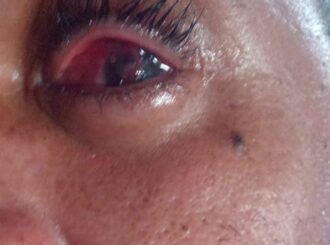 Homem ficou cego de um olho após cirurgia ocular no HGR, diz denúncia