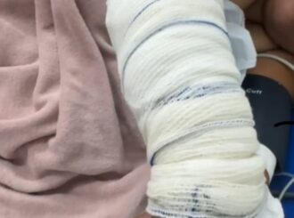 Jovem tem 40% do corpo queimado após ex-marido incendiar casa no Cantá; suspeito está foragido