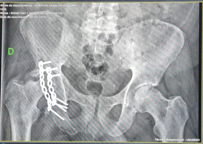 Homem que sofreu acidente há um ano reclama de demora na realização de cirurgia no HGR e cobra pelo procedimento: ‘dores insuportáveis’