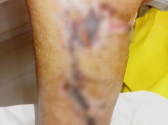 Mulher vítima de acidente de trânsito e com risco de perder a perna, pede ajuda para comprar medicamentos e sobreviver