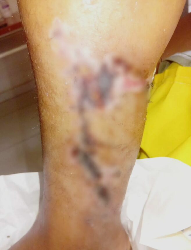 Mulher vítima de acidente de trânsito e com risco de perder a perna, pede ajuda para comprar medicamentos e sobreviver