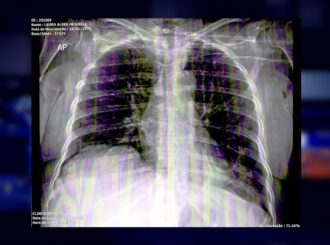 Paciente espera há oito meses por TFD para realizar cirurgia na coluna