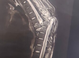 Jovem aguarda há 50 dias por cirurgia; médicos alegam falta de material