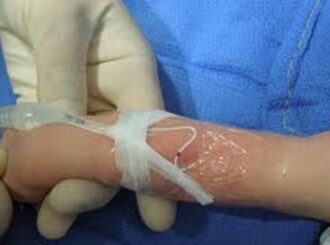 Roraima registra 75 incidentes associados aos cuidados de recém-nascidos entre 2014 e 2022