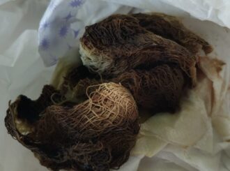 Gazes “apodrecidas” são encontradas dentro de mulher após 10 dias de parto em Boa Vista; aponta denúncia