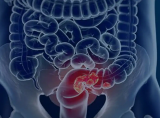 Rastreamento para câncer colorretal pode ser implementado no SUS