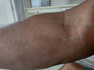 Paciente denuncia negligência no HGR por ficar com fragmento de cateter no braço