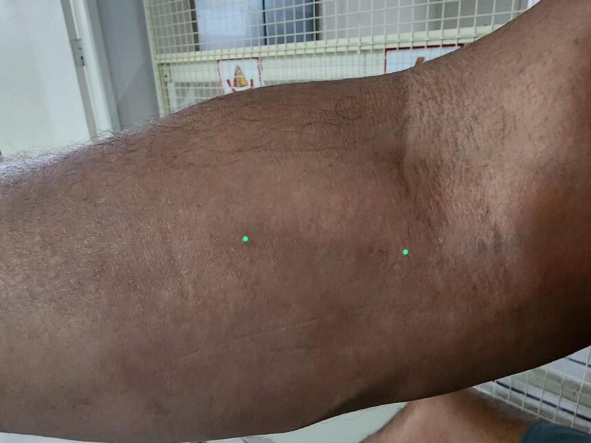 Paciente denuncia negligência no HGR por ficar com fragmento de cateter no braço