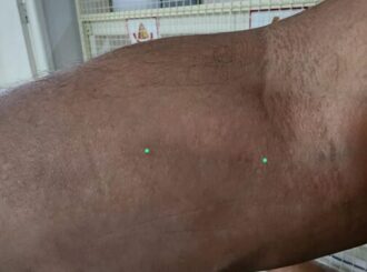 Paciente denuncia negligência no HGR por ficar com fragmento de cateter no braço