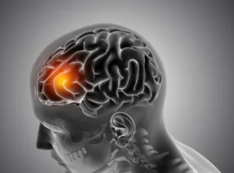 Neurologista comenta aumento de casos de AVC em jovens