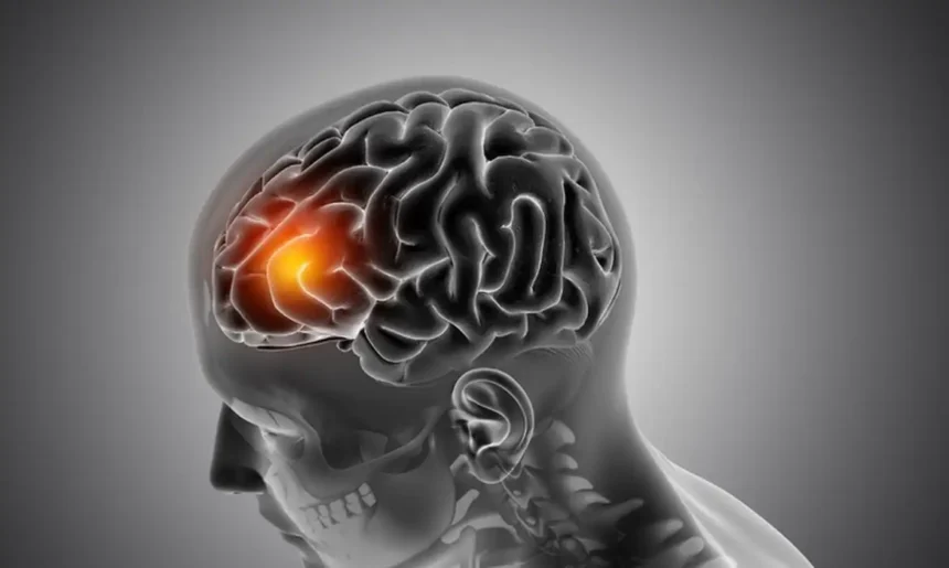 Neurologista comenta aumento de casos de AVC em jovens